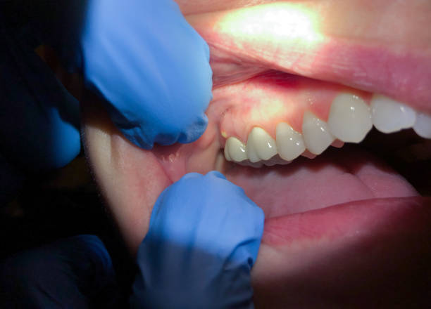 Best Emergency Wisdom Teeth Removal in Ambler, PA